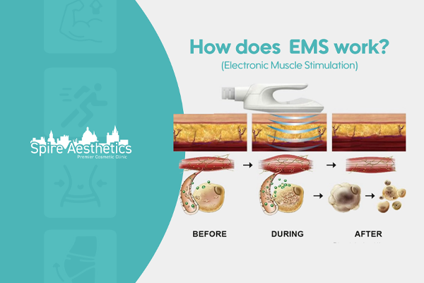 EMS treatment for post pregnancy weight loss treatment Caversham