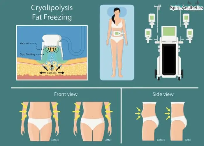 Fat freezing treatment Caversham benefits for competitions to remove stubborn fat deposits.