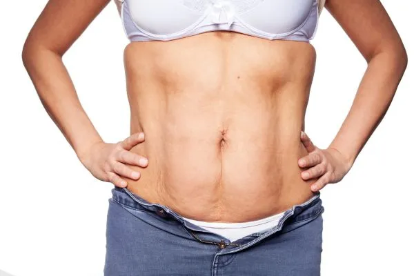 sagging skin on woman's stomach after weight loss injections Caversham