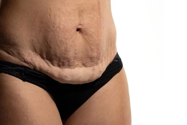 Image of womans stomach after weight loss injections Caversham showing saggy skin