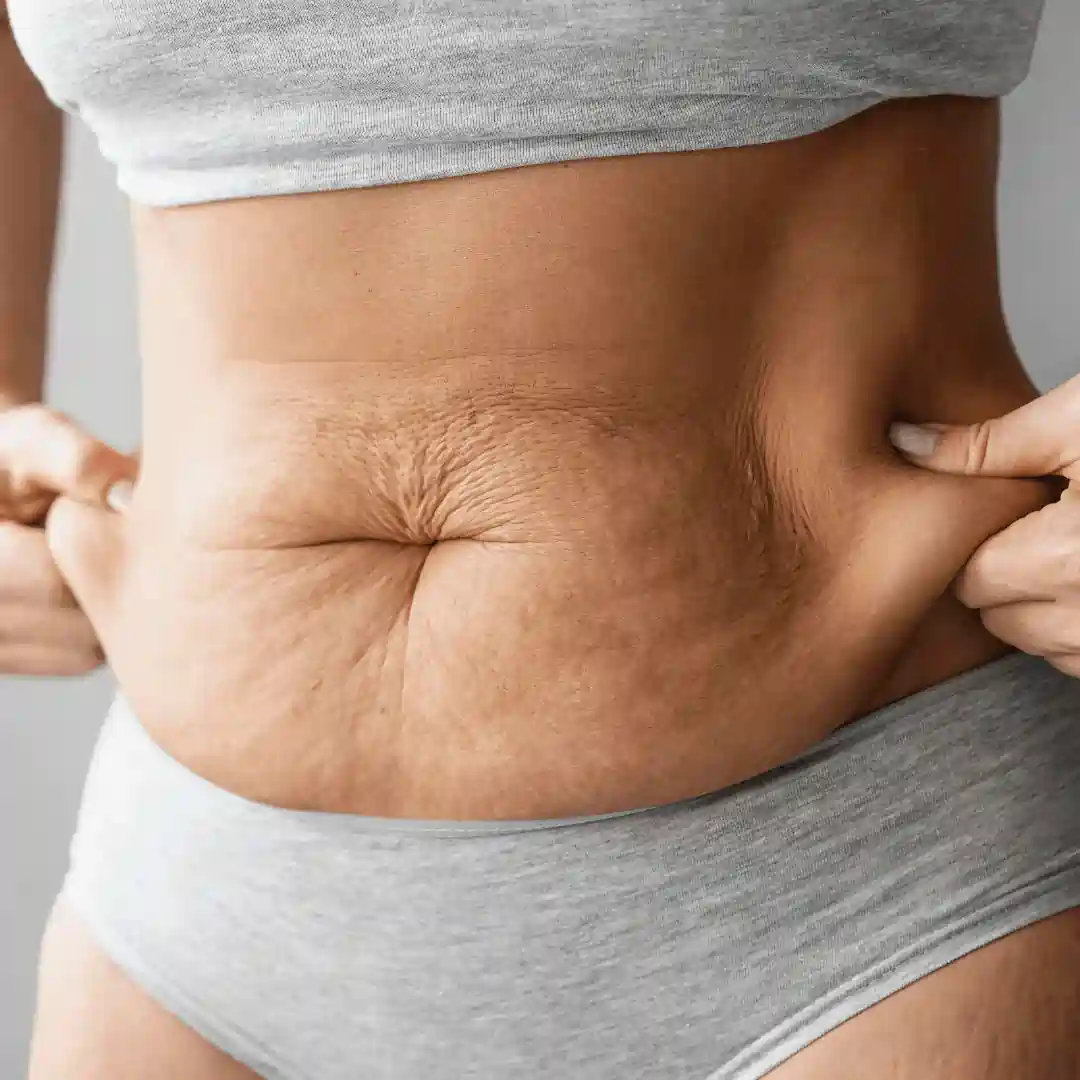 Is It Normal to Have Loose Skin After Pregnancy Caversham?