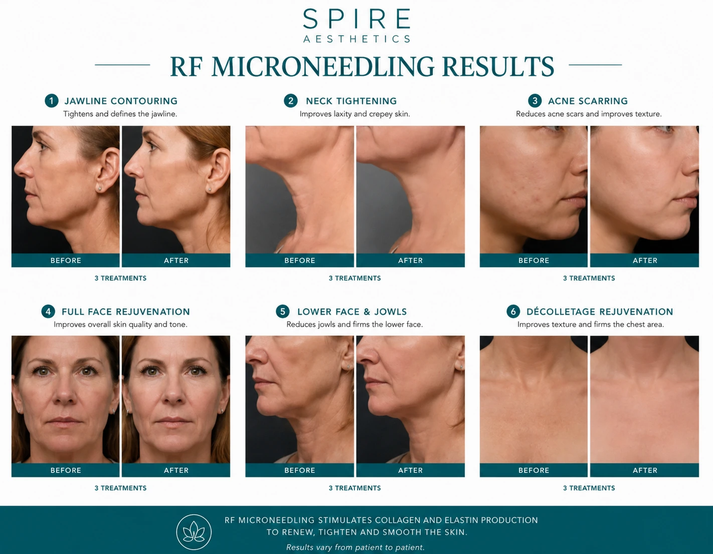 RF Microneedling Skin tightening Caversham results