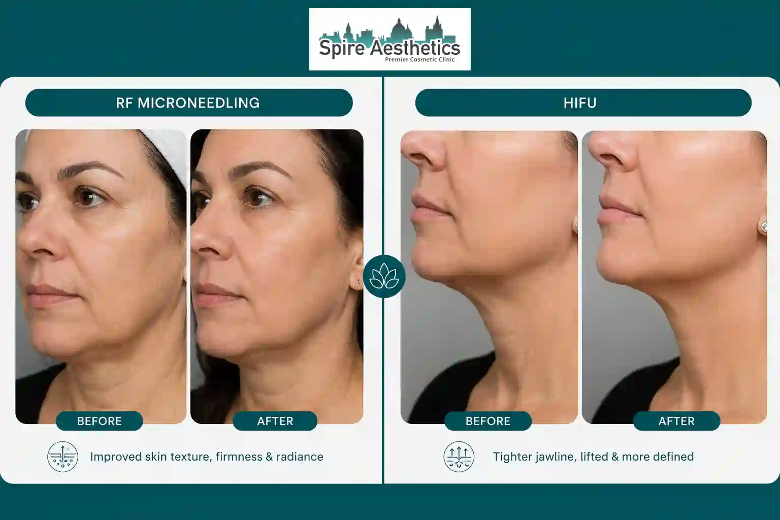 Can RF Microneedling and HIFU Be Combined Caversham?