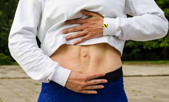 When Could Diastasis Recti Be the Missing Piece of the Puzzle Caversham?