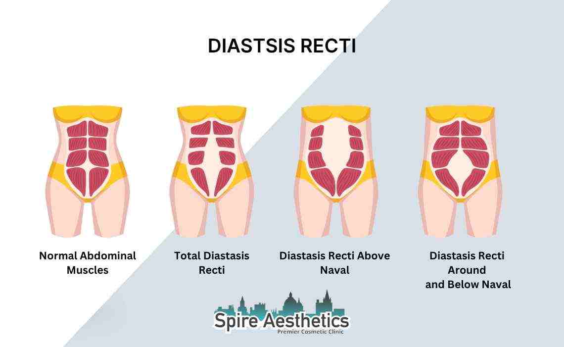 Is Non-Surgical Diastasis Recti Treatment Right for You? Common Concerns Answered Caversham